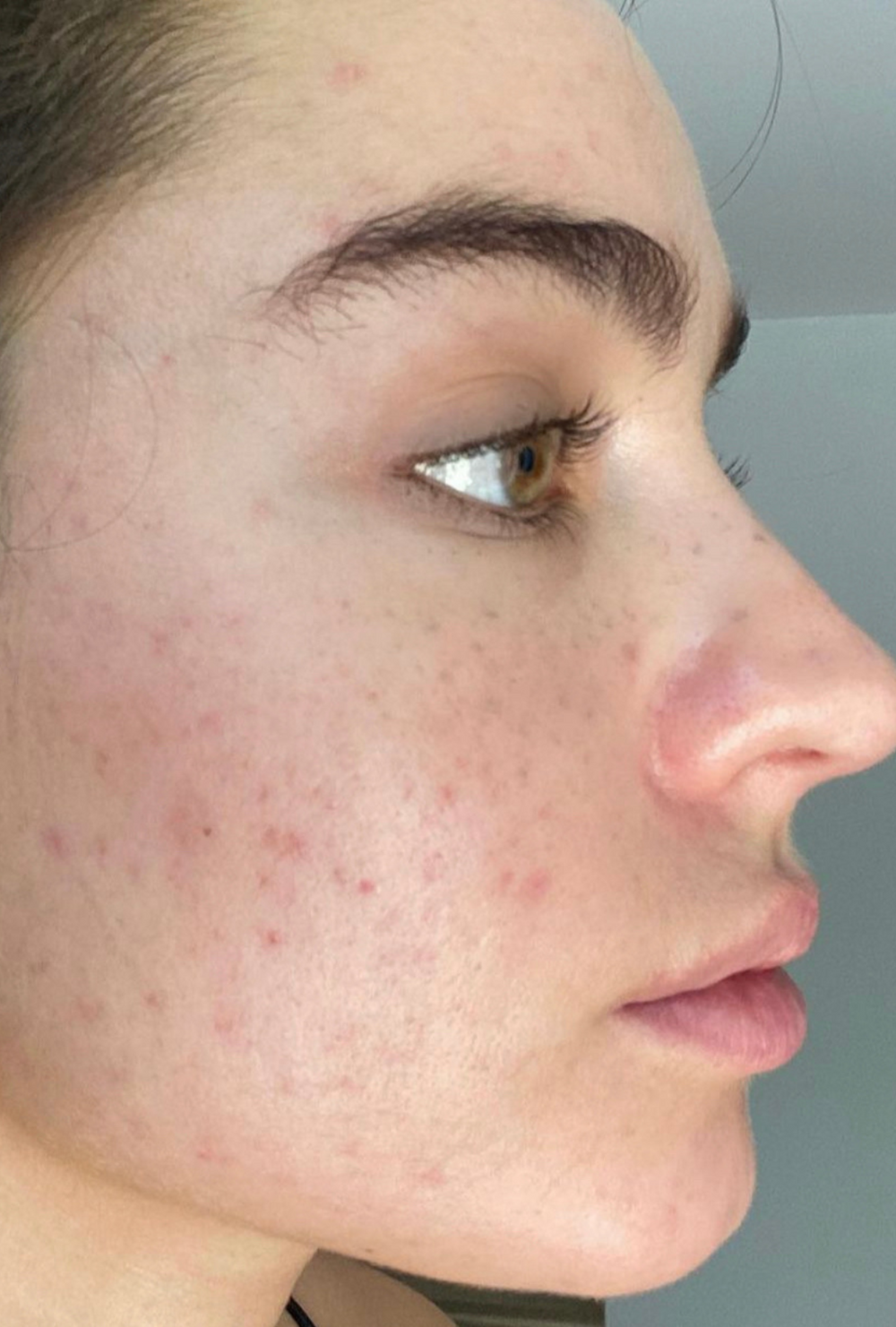 Close-up side profile of a woman’s face showing mild hormonal acne and redness on the cheek and jawline before using IMARAÏS BEAUTY Clarity gummies.