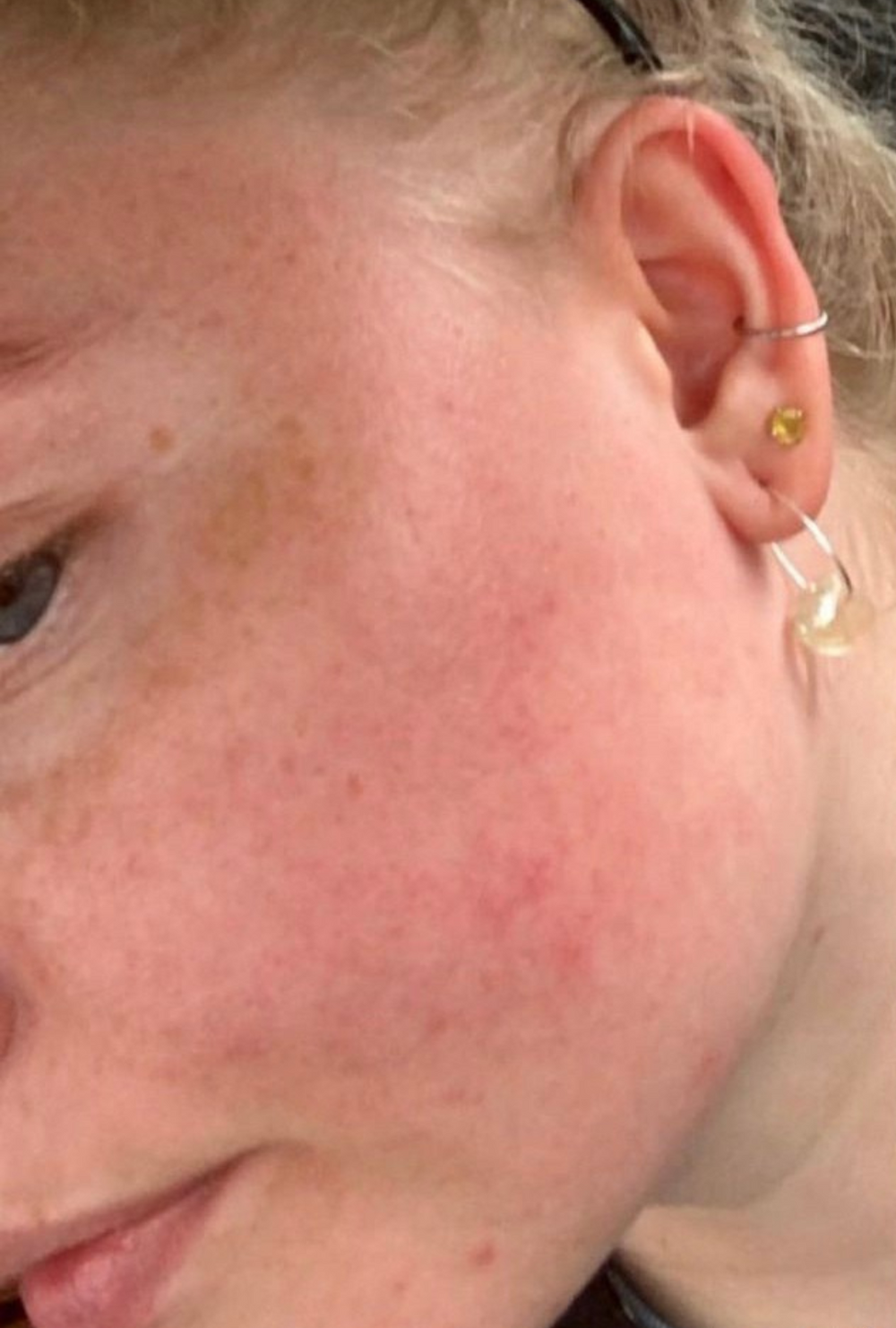 Close-up of a woman's cheek and jawline showing visible redness, uneven skin tone, and mild irritation before using IMARAÏS BEAUTY GLOW gummies.