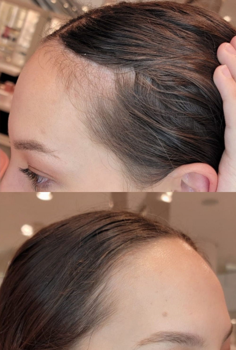 Side-by-side comparison of a woman’s hairline before and after using IMARAÏS BEAUTY NOURISH gummies, highlighting fuller regrowth and improved hair density around the temple and forehead area.