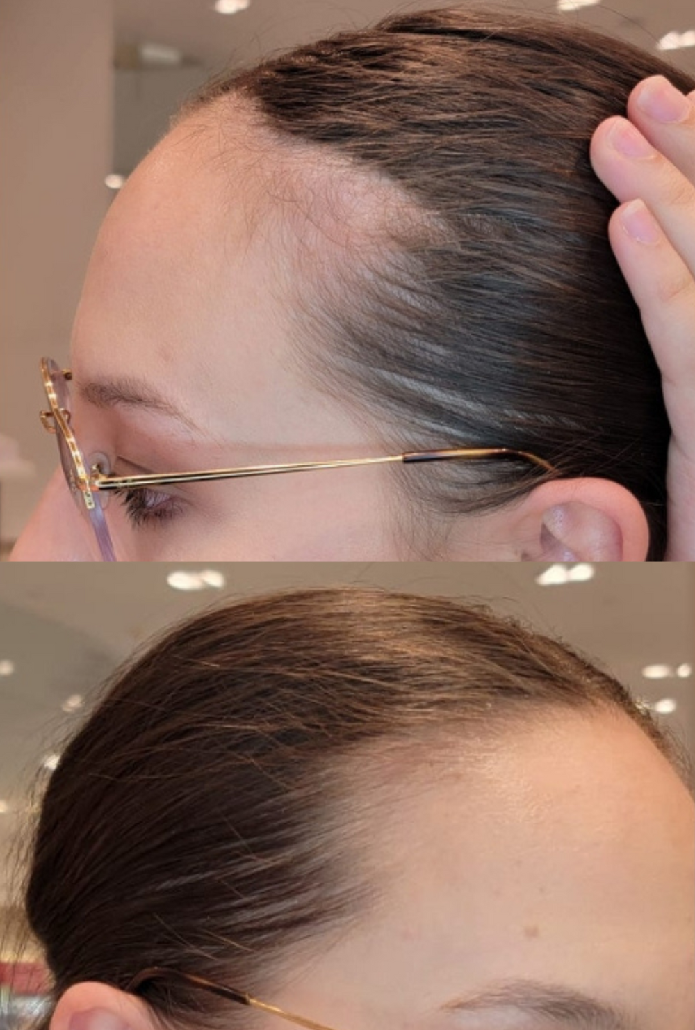 "Side-by-side comparison of a woman’s hairline before and after using IMARAÏS BEAUTY NOURISH gummies, showing visible improvement in hair density and reduced thinning near the temples.